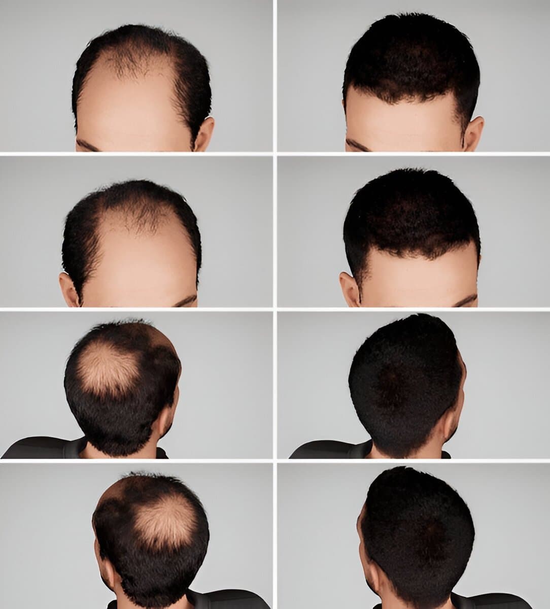 Hair Loss Treatments