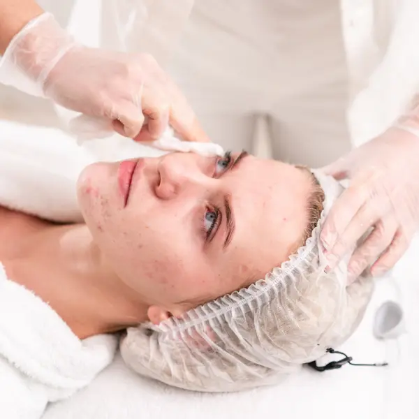 Acne and Acne Scars
