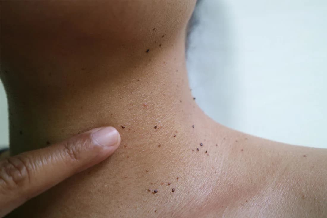 Skin Tag, Mole and Wart Removal